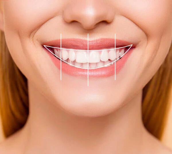 Full Mouth dental implants